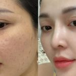 có nên tiêm meso không