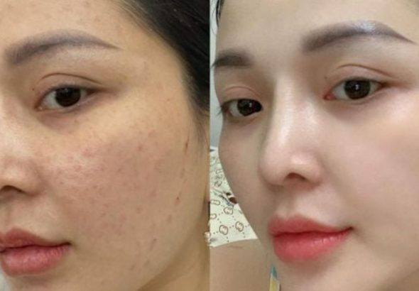 có nên tiêm meso không